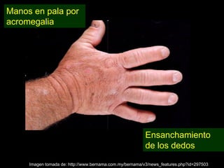 Acromegalia