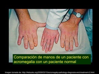 Acromegalia