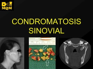 CONDROMATOSIS
   SINOVIAL
 