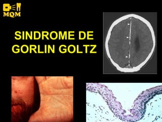 SINDROME DE
GORLIN GOLTZ
 