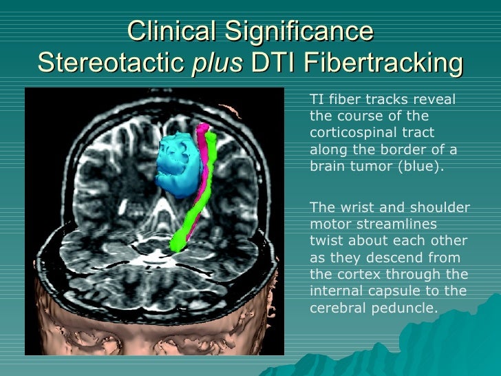 DTI Fiber Tracking dti-fiber-tracking
