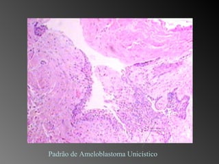Padrão de Ameloblastoma Unicístico 