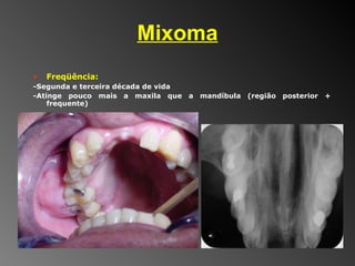 Mixoma Freqüência:  -Segunda e terceira década de vida -Atinge pouco mais a maxila que a mandíbula (região posterior + frequente)  