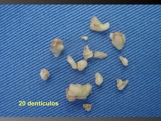 20 dentículos 