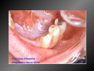 Prof Cleto Piazzetta   Diagnóstico Bucal UFPR 