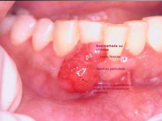 Granuloma Piogênico Lesão Nodular Séssil ou pediculada Avermelhada ou vinhosa Sangramento espontâneo e áreas de micro-ulceração superficial 