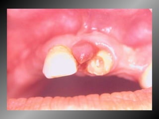 Granuloma Periférico de Células Gigantes 