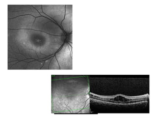 Comprehensive Overview of Congenital Retinal Disorders and Their ...
