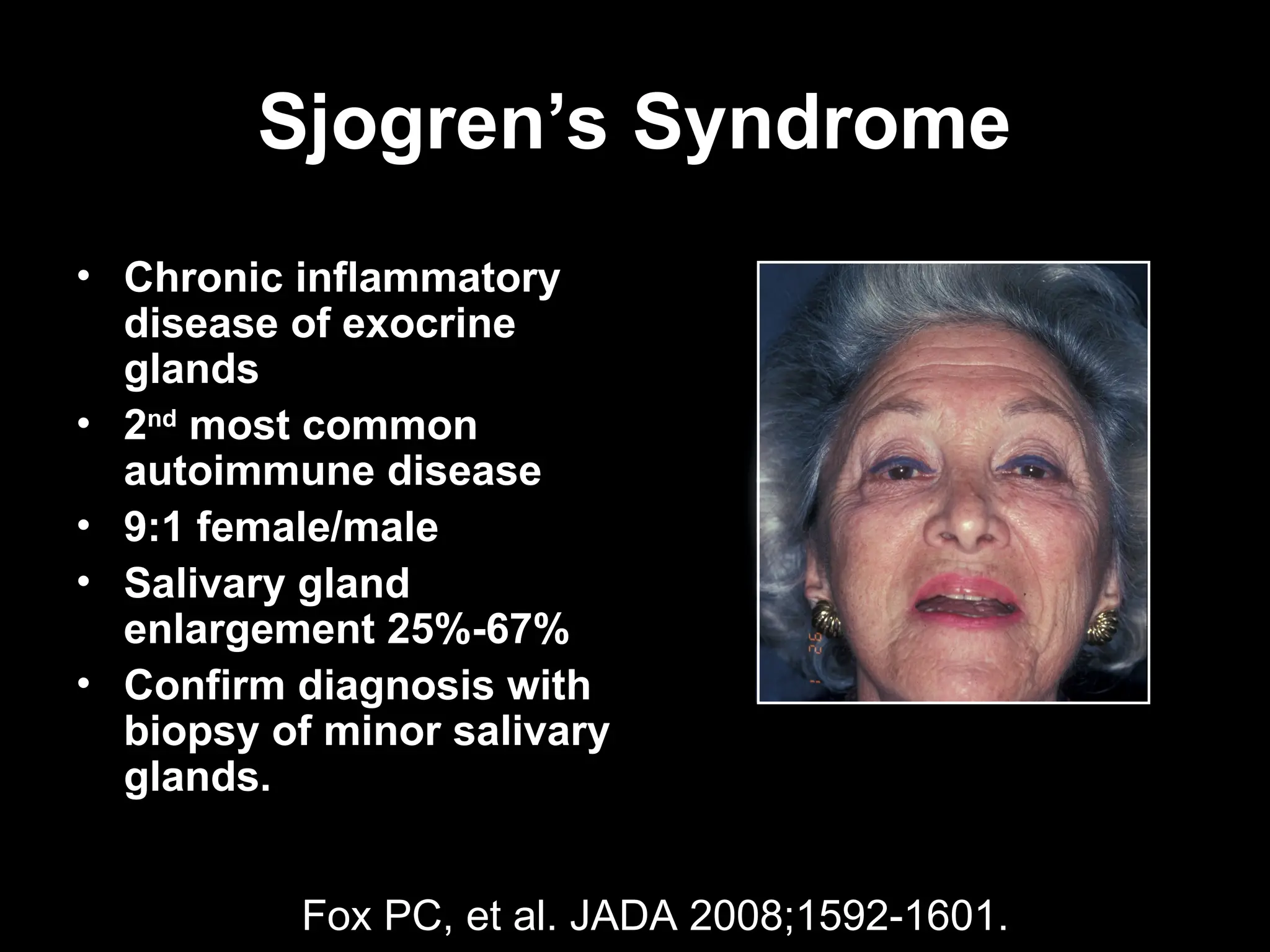 Sjogren’s Syndrome
Sjogren’s Syndrome
• Chronic inflammatory
disease of exocrine
glands
• 2nd
most common
autoimmune disease
• 9:1 female/male
• Salivary gland
enlargement 25%-67%
• Confirm diagnosis with
biopsy of minor salivary
glands.
Fox PC, et al. JADA 2008;1592-1601.
 