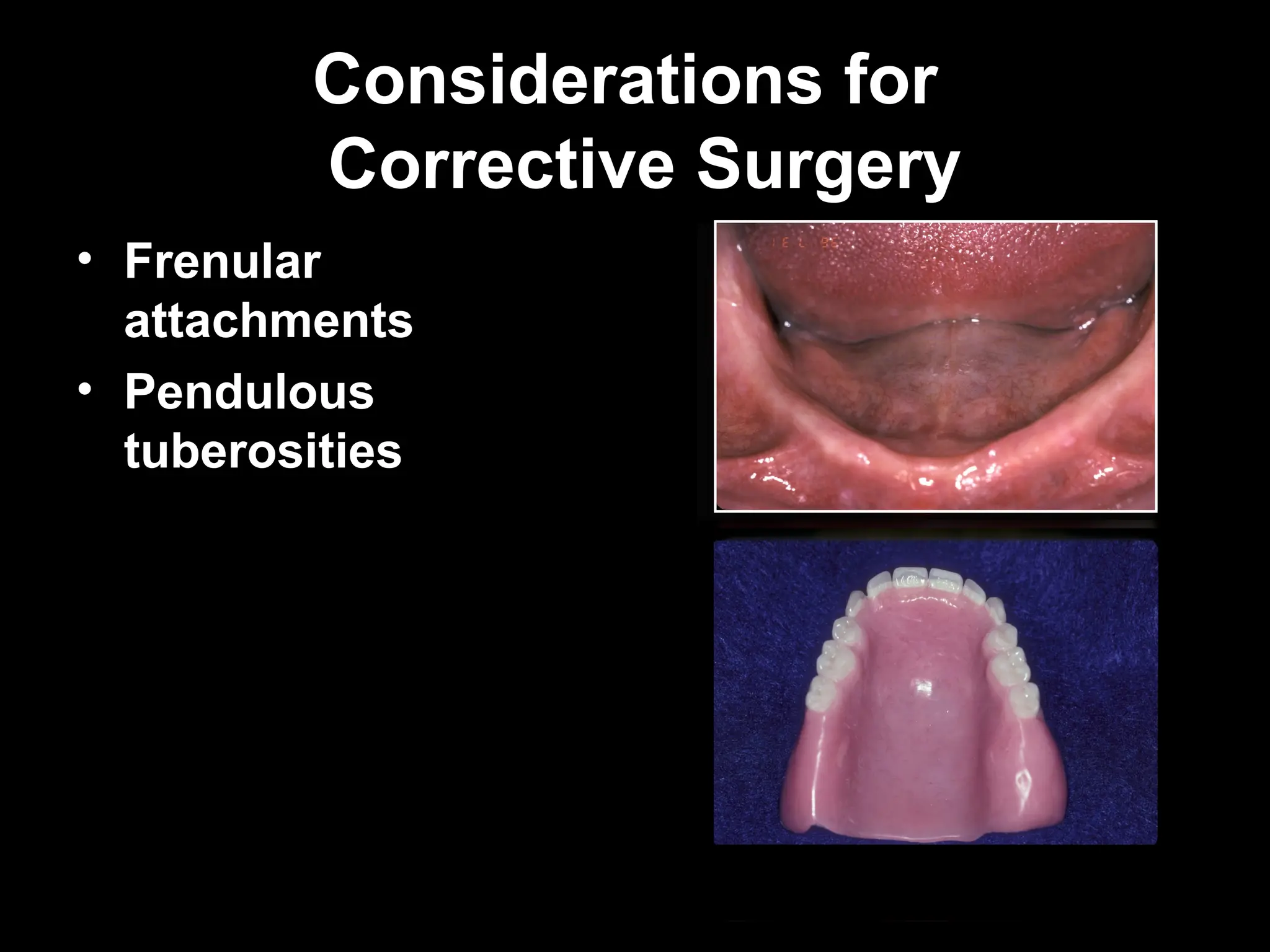 Considerations for
Considerations for
Corrective Surgery
Corrective Surgery
• Frenular
attachments
• Pendulous
tuberosities
 