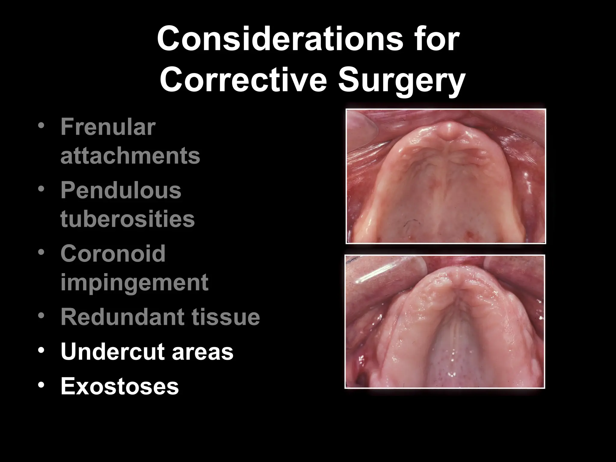 Considerations for
Considerations for
Corrective Surgery
Corrective Surgery
• Frenular
attachments
• Pendulous
tuberosities
• Coronoid
impingement
• Redundant tissue
• Undercut areas
• Exostoses
 