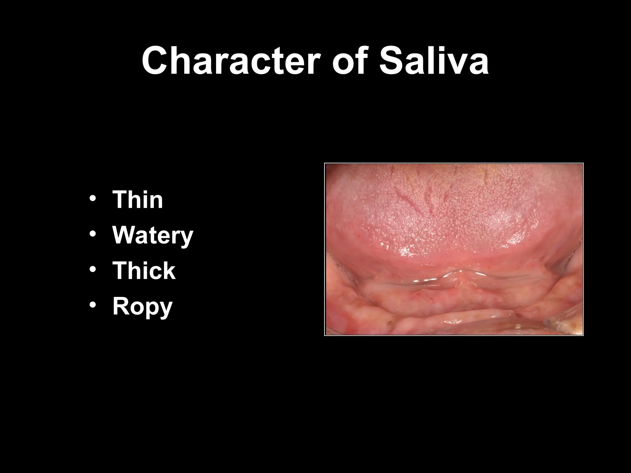 Character of Saliva
Character of Saliva
• Thin
• Watery
• Thick
• Ropy
 
