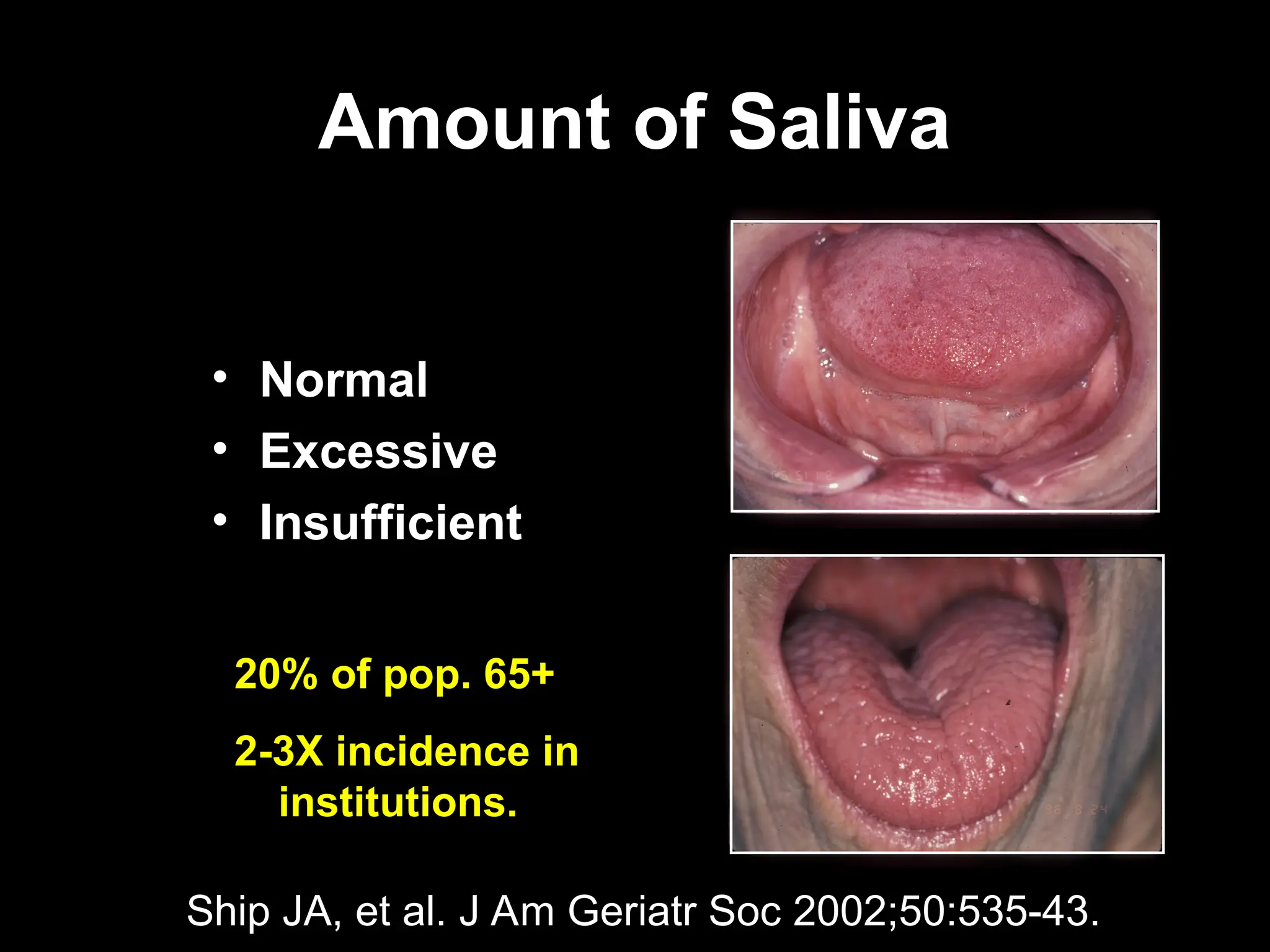Amount of Saliva
Amount of Saliva
• Normal
• Excessive
• Insufficient
Ship JA, et al. J Am Geriatr Soc 2002;50:535-43.
20% of pop. 65+
2-3X incidence in
institutions.
 