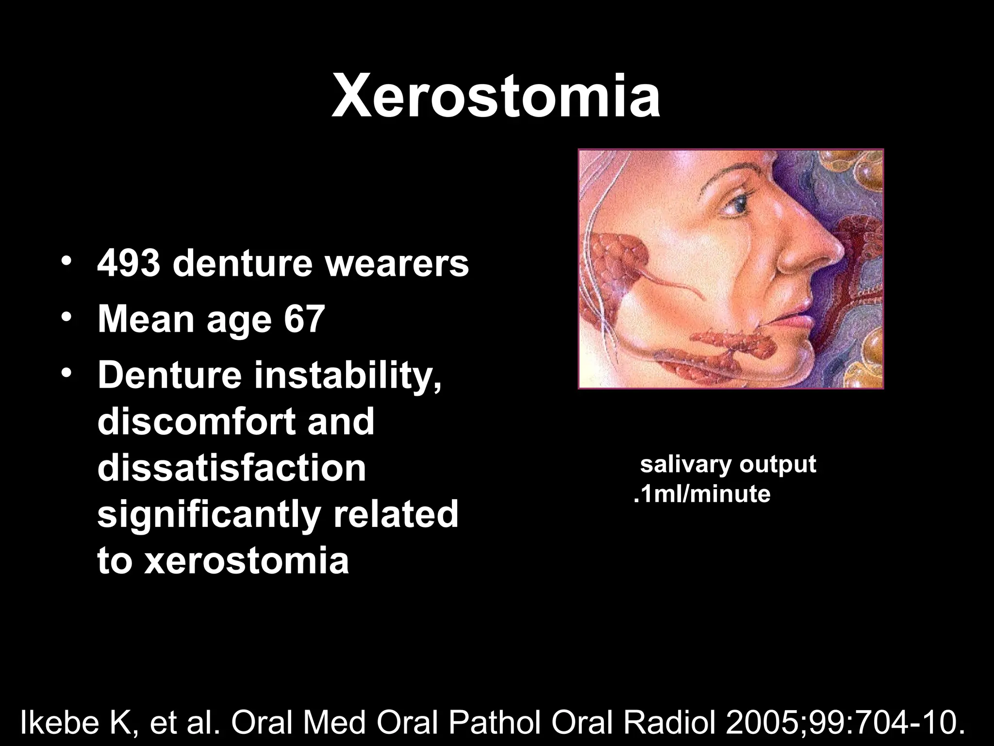 Xerostomia
Xerostomia
• 493 denture wearers
• Mean age 67
• Denture instability,
discomfort and
dissatisfaction
significantly related
to xerostomia
Ikebe K, et al. Oral Med Oral Pathol Oral Radiol 2005;99:704-10.
salivary output
.1ml/minute
 