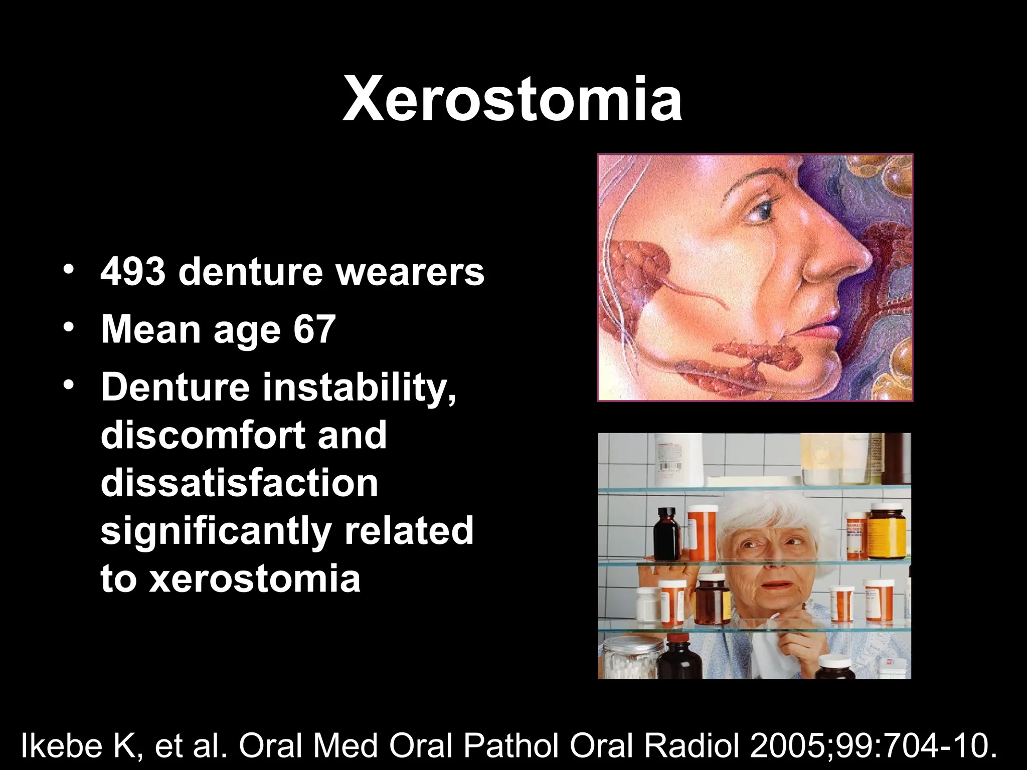 Xerostomia
Xerostomia
• 493 denture wearers
• Mean age 67
• Denture instability,
discomfort and
dissatisfaction
significantly related
to xerostomia
Ikebe K, et al. Oral Med Oral Pathol Oral Radiol 2005;99:704-10.
 