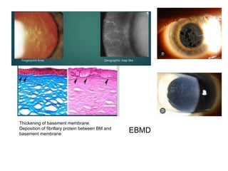 corneal dystrophies a comparative table of all 4 types | PPTX