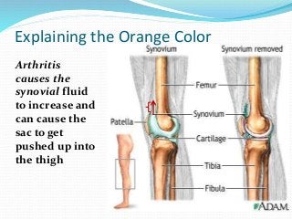 Arthritis
causes the
synovial fluid
to increase and
can cause the
sac to get
pushed up into
the thigh
Explaining the Orange Color
 