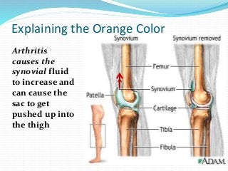 Arthritis
causes the
synovial fluid
to increase and
can cause the
sac to get
pushed up into
the thigh
Explaining the Orange Color
 