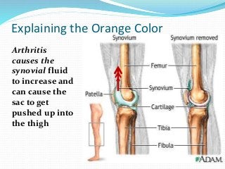 Arthritis
causes the
synovial fluid
to increase and
can cause the
sac to get
pushed up into
the thigh
Explaining the Orange Color
 