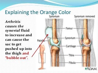 Arthritis
causes the
synovial fluid
to increase and
can cause the
sac to get
pushed up into
the thigh and
“bubble out”.
Explaining the Orange Color
 