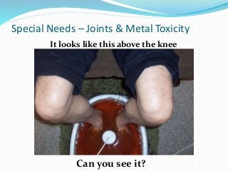 It looks like this above the knee
Special Needs – Joints & Metal Toxicity
Can you see it?
 