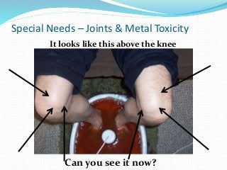 It looks like this above the knee
Special Needs – Joints & Metal Toxicity
Can you see it now?
 