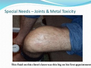 Special Needs – Joints & Metal Toxicity
This fluid on this client’s knee was this big on his first appointment
 