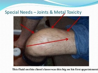 Special Needs – Joints & Metal Toxicity
This fluid on this client’s knee was this big on his first appointment
 