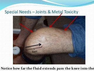 Special Needs – Joints & Metal Toxicity
Notice how far the fluid extends pass the knee into the
 