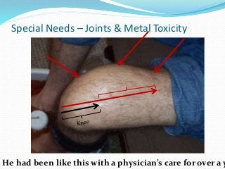 Special Needs – Joints & Metal Toxicity
He had been like this with a physician’s care for over a y
 