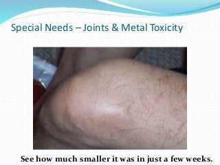 Special Needs – Joints & Metal Toxicity
See how much smaller it was in just a few weeks.
 