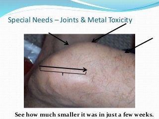 Special Needs – Joints & Metal Toxicity
See how much smaller it was in just a few weeks.
 