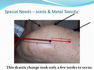 Special Needs – Joints & Metal Toxicity
This drastic change took only a few weeks to occur.
 