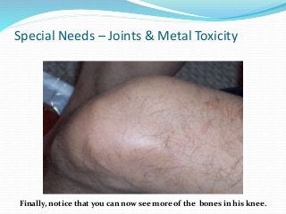 Special Needs – Joints & Metal Toxicity
Finally, notice that you can now see more of the bones in his knee.
 