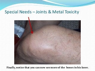 Special Needs – Joints & Metal Toxicity
Finally, notice that you can now see more of the bones in his knee.
 