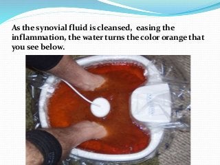 As the synovial fluid is cleansed, easing the
inflammation, the water turns the color orange that
you see below.
 
