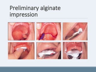 Preliminary alginate
impression
 