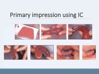 Primary impression using IC
 