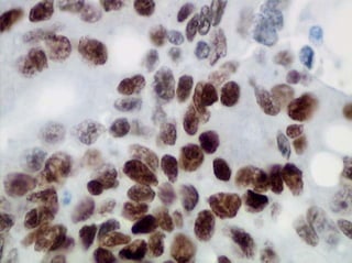 CDX2 in Colon Carcinoma