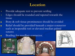Major connectors of mandible in rapid partial denture | PDF