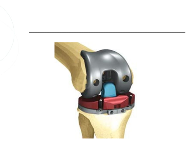 Ceļa locītavas totāla endoprotezēšana | PPT