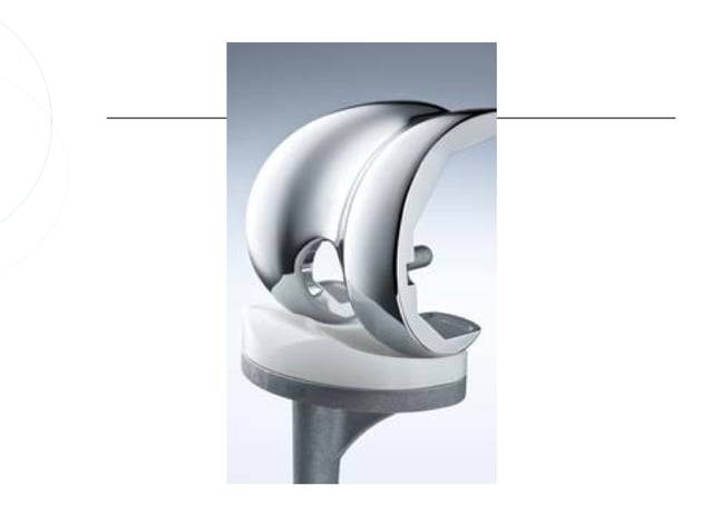 Ceļa locītavas totāla endoprotezēšana | PPT