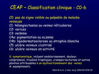 CEAP – Classification clinique - C0-6
C0: pas de signe visible ou palpable de maladie
veineuse
C1: télangiectasies ou veines réticulaires
C2: varices
C3: oedeme
C4a: pigmentation ou eczema
C4b: lipodermatosclerose ou atrophie blanche
C5: ulcère veineux cicatrisé
C6: ulcère veineux en activité

S: symptomatique, incluant endolorissement, douleur,
compression, troubles trophiques, crampes nocturnes et autres
plaintes attribuables à un dysfonctionnement des veines
A: asymptomatic
                                Eklof B et al. J Vasc Surg. 2004;40:1248-52
 