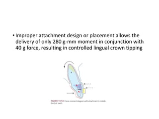 • Improper attachment design or placement allows the
delivery of only 280 g-mm moment in conjunction with
40 g force, resulting in controlled lingual crown tipping
 