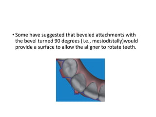 • Some have suggested that beveled attachments with
the bevel turned 90 degrees (i.e., mesiodistally)would
provide a surface to allow the aligner to rotate teeth.
 
