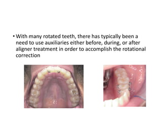 • With many rotated teeth, there has typically been a
need to use auxiliaries either before, during, or after
aligner treatment in order to accomplish the rotational
correction
 