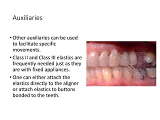 Auxiliaries
• Other auxiliaries can be used
to facilitate specific
movements.
• Class II and Class III elastics are
frequently needed just as they
are with fixed appliances.
• One can either attach the
elastics directly to the aligner
or attach elastics to buttons
bonded to the teeth.
 
