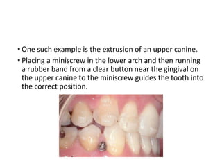 • One such example is the extrusion of an upper canine.
• Placing a miniscrew in the lower arch and then running
a rubber band from a clear button near the gingival on
the upper canine to the miniscrew guides the tooth into
the correct position.
 
