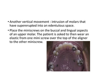 • Another vertical movement : intrusion of molars that
have supererupted into an edentulous space.
• Place the miniscrews on the buccal and lingual aspects
of an upper molar. The patient is asked to then wear an
elastic from one mini screw over the top of the aligner
to the other miniscrew.
 