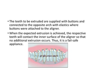 • The teeth to be extruded are supplied with buttons and
connected to the opposite arch with elastics where
buttons were attached to the aligner.
• When the expected extrusion is achieved, the respective
teeth will contact the inner surface of the aligner so that
no additional extrusion occurs. Thus, it is a fail-safe
appliance.
 